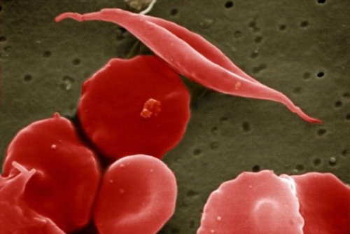 Gene Therapy For Sickle Cell Disease Appears Safe And Effective In