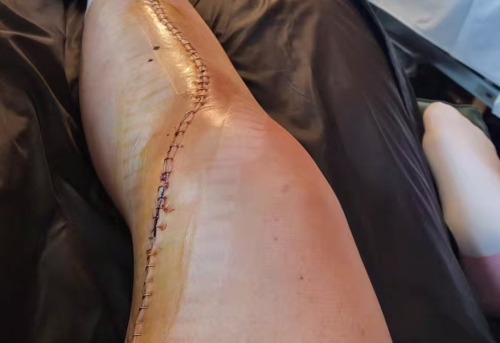 «Rekord an Stichen»: Brignone zeigt Bild von operiertem Bein