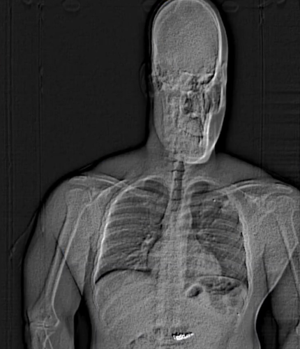 Juwelier erleichtert – Röntgenbild überführt Ohrring-Dieb
