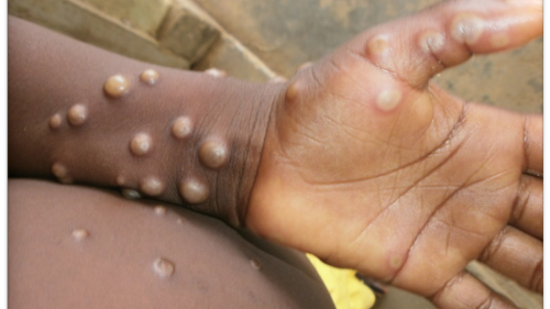 Monkeypox: Australia reports first case of virus in man returning from UK