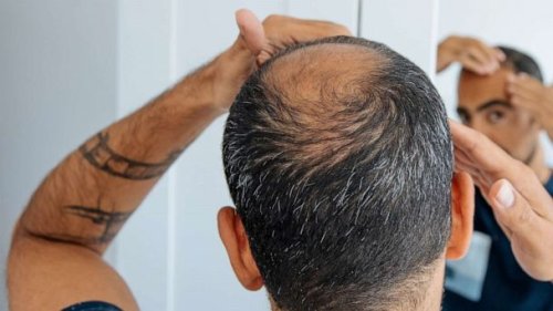 New study finds some natural hair loss supplements may actually work