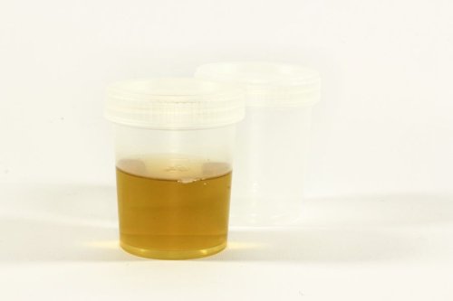 Testing urine for prostate cancer - the crystal ball in your bladder