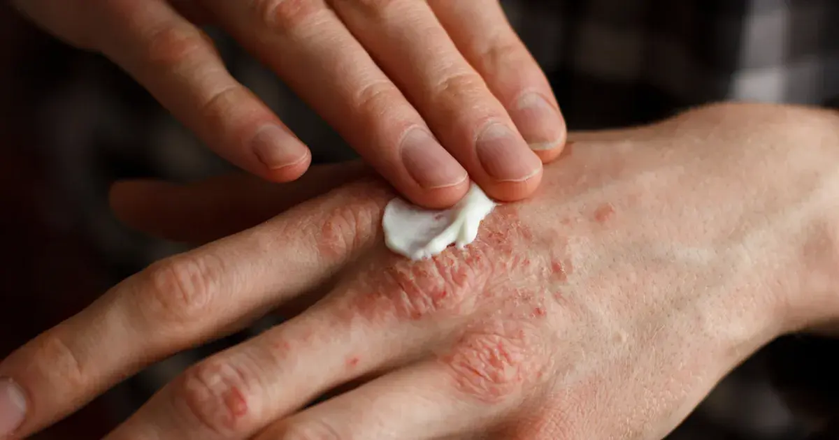 A Complete Guide To Living With Psoriasis