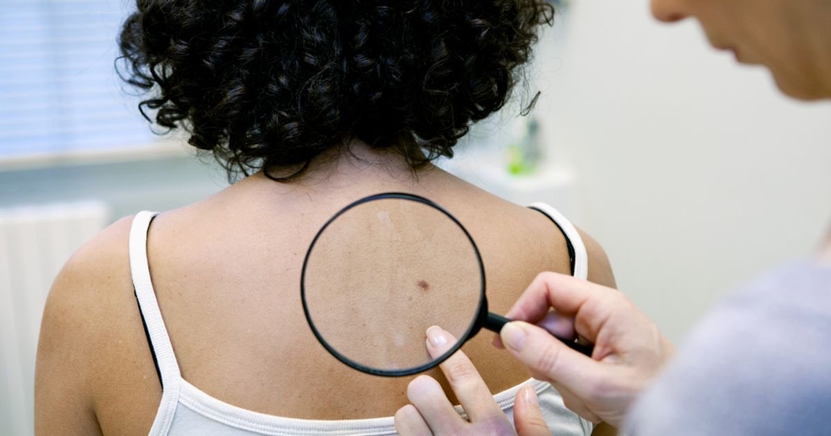 Skin Cancer Symptoms That are More Than Skin Deep