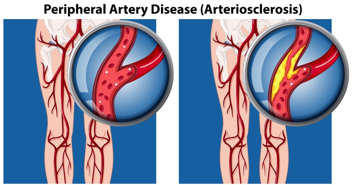 Peripheral Artery Disease (PAD): Symptoms, Causes, and Treatment