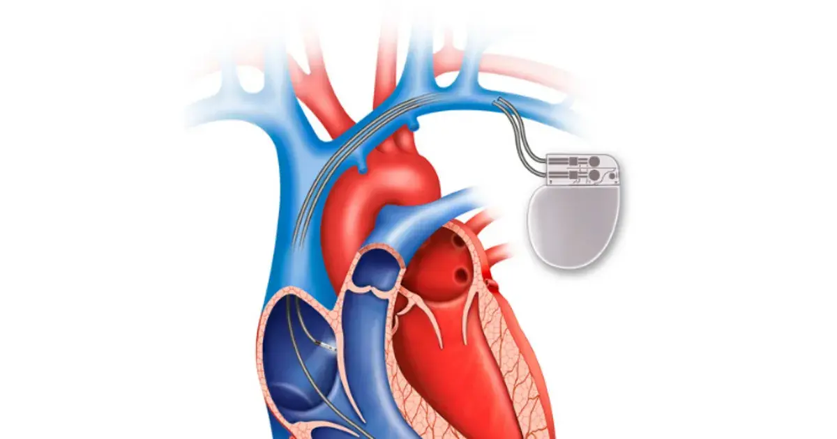 A Complete Guide to Living With a Pacemaker