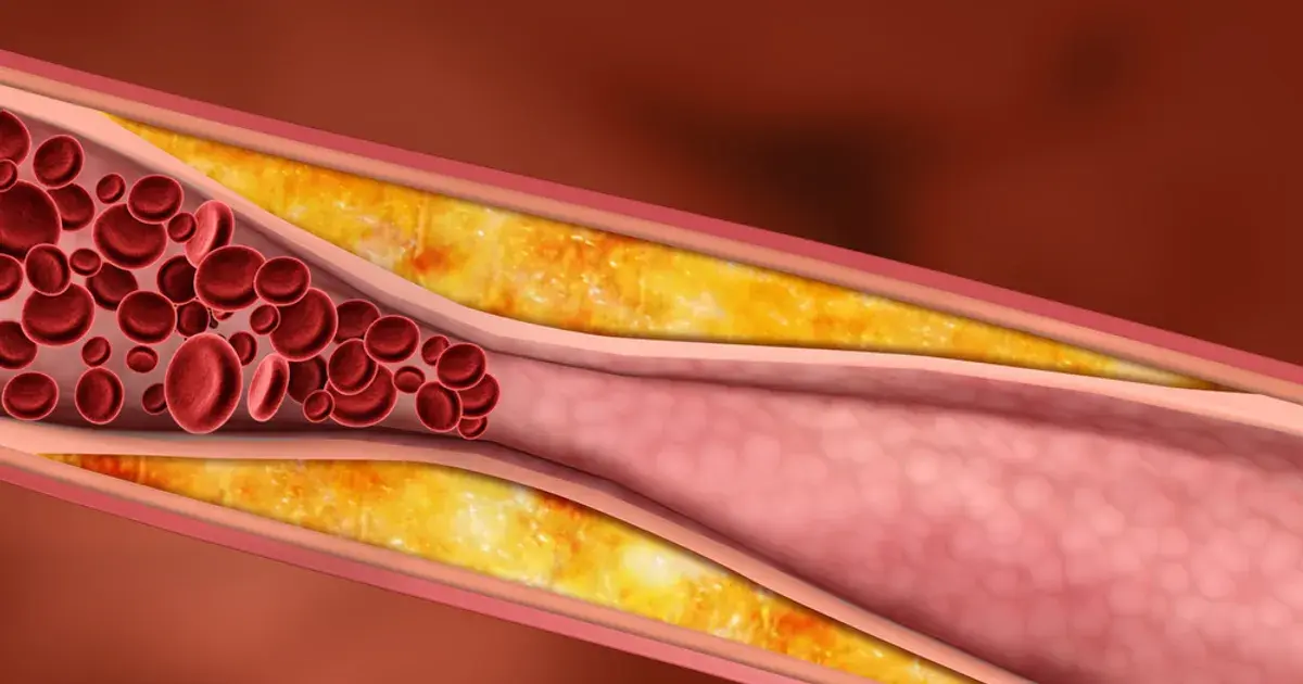 The Truth About Cholesterol