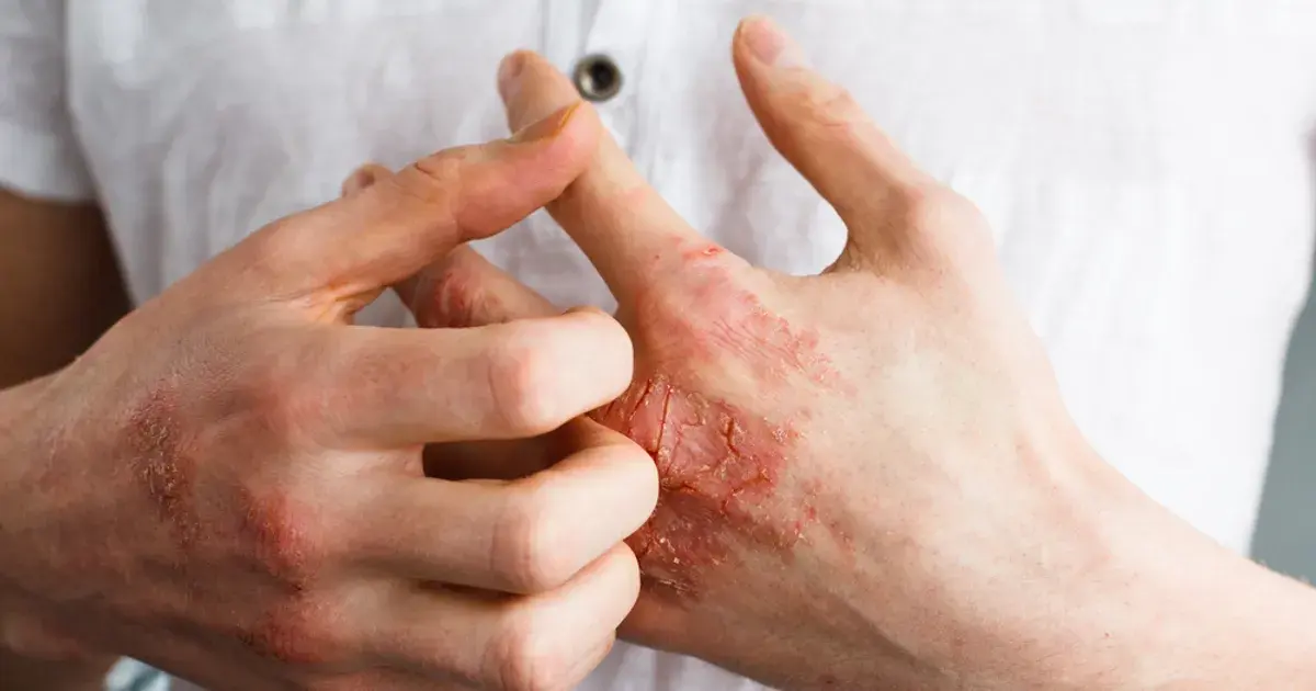 Eczema: Signs, Symptoms, and Treatment Options