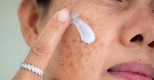 Melasma: Signs, Causes, Treatment, and Prevention - ActiveBeat