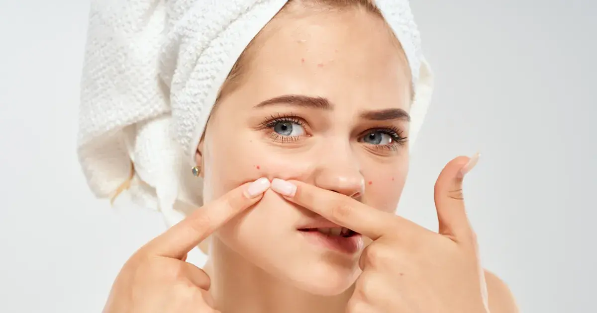 Best Ways to Prevent Acne: Avoid Breakouts With These Tips!