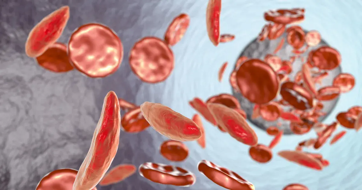 Signs and Symptoms of Sickle Cell Anemia