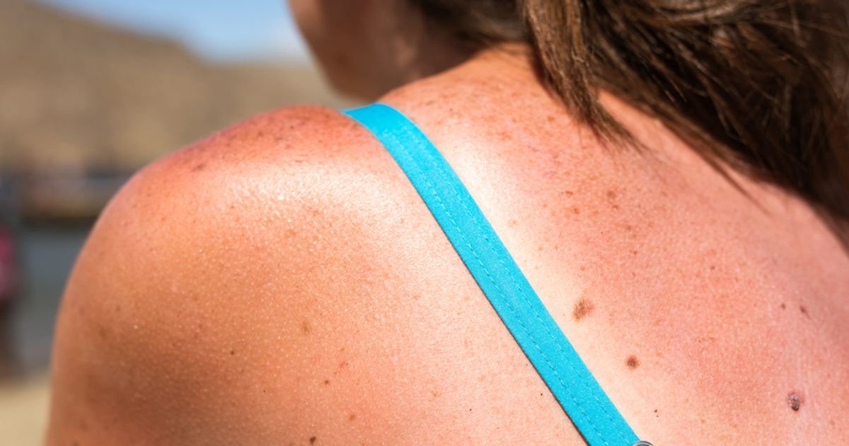 Factors That Increase Your Risk of Skin Cancer