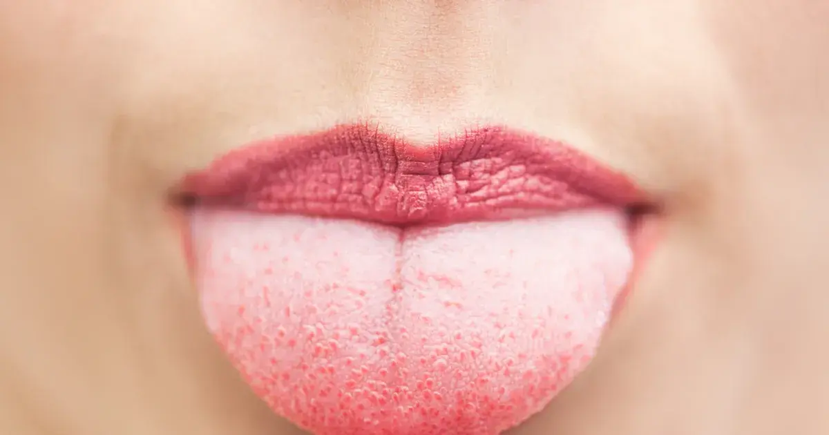 7 Things Your Tongue is Saying About Your Health