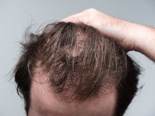 Il promet de faire repousser les cheveux : ce que cache ce nouveau spray contre la calvitie vendu en pharmacie