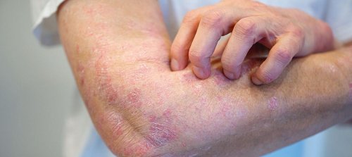 Psoriasis und Psoriasis-Arthritis bei älteren Menschen: Bei Interleukin-Hemmern ist das Risiko für schwere Infektionen geringer als bei anderen Medikationen – Deutsches Ärzteblatt