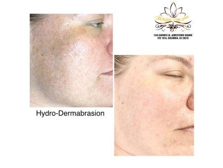 The Hydrodermabrasion facial is a aqua skin resurfacing treatment