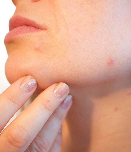 Antibiotic Treatment for Acne Can Impair Skeletal Growth in Adolescents