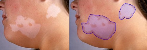 Image Annotations: For AI driven Skin Conditions Diagnosis