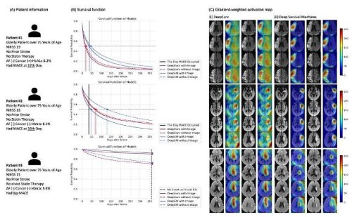 Researchers develop AI technology capable of predicting cardiovascular events for stroke patients