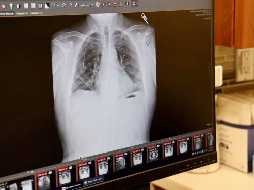 Lung cancer pill cuts risk of death by half, study finds