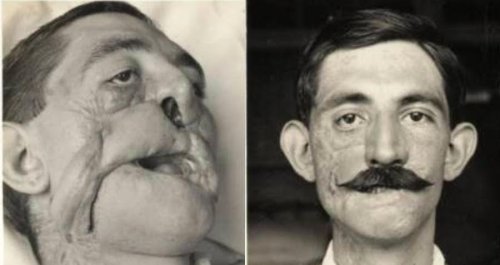 25 Before-And-After Pictures Of World War I Soldiers Who Were Helped By Pioneering Plastic Surgeon Harold Gillies