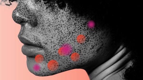 How to Get Rid of Cystic Acne Once and for All, According to Dermatologists