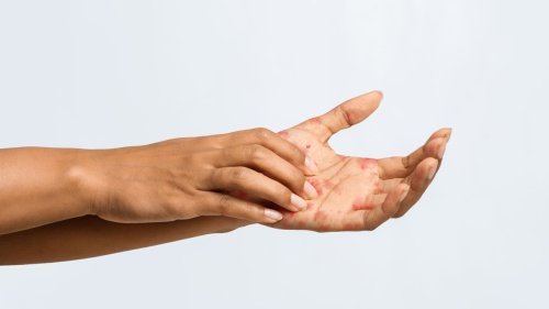 Eczema Can Be Tougher on Black and Latinx Skin—Here’s Why