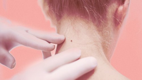Here’s Exactly What to Expect at a Skin Cancer Check
