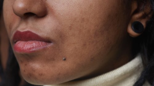 How to Treat Acne and Post-Acne Marks on Dark Skin, According to a Dermatologist — See Video