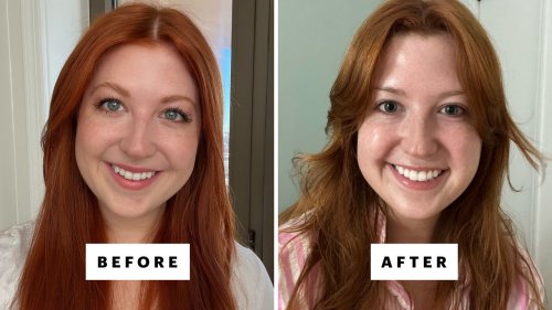 Getting Jawline Injections Left Me With a Distorted Smile