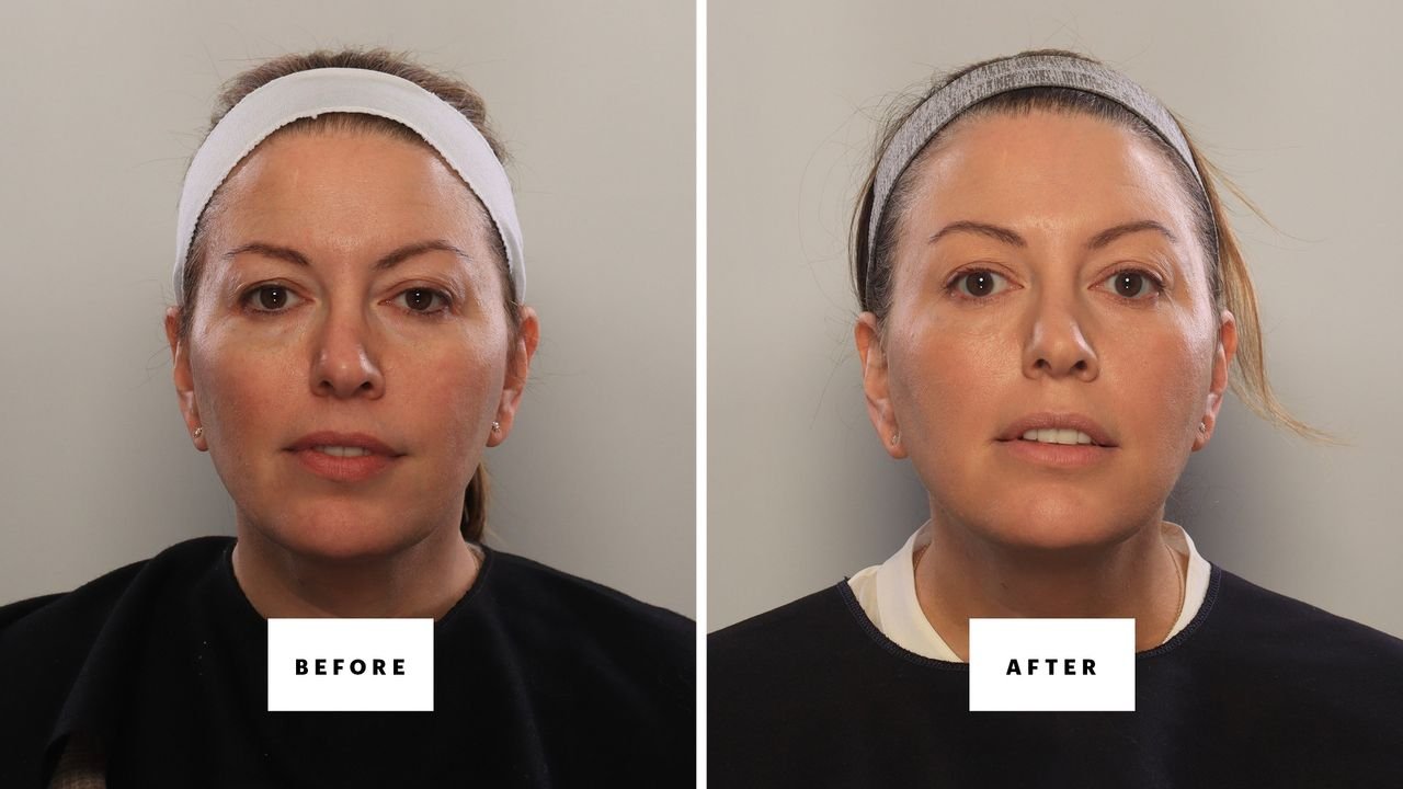 Can You Fake a Blepharoplasty? I Gave It My Best Shot