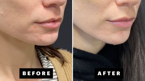 I Tried the New AviClear Laser for My Hormonal and Cystic Acne