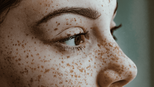 The fascinating science behind what causes freckles