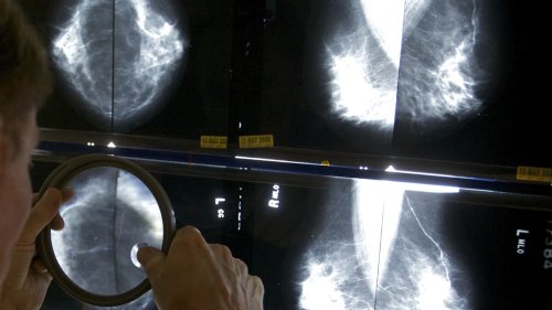 Advanced cancers returned to prepandemic levels, according to a reassuring report