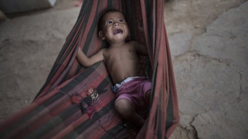 Virus-linked hunger tied to 10,000 child deaths each month