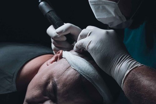 Hair loss, robot transplants: Inside the multi-billion dollar industry battling baldness - Arabian Business