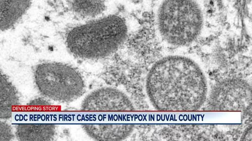 Duval County Health Department confirms two cases of Monkeypox in Jacksonville