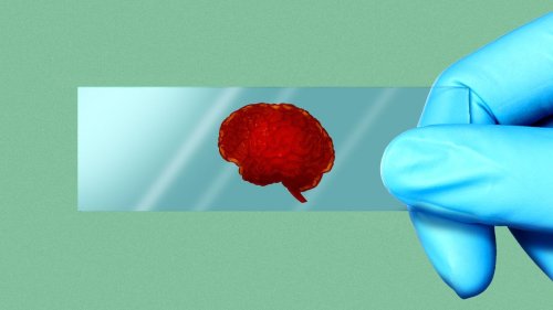 FDA clears first blood test to diagnose Alzheimer's