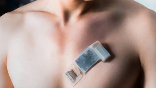 Kabellos: Dieses tragbare Ultraschall-Pflaster kann Gewebe überwachen