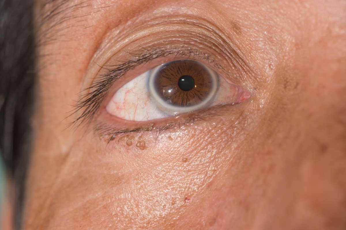 If You Notice This in Your Eyes, Get Your Heart Checked, Experts Say