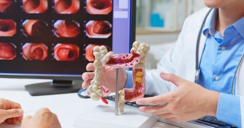 50% of Colon Cancer Cases in Young People Tied to 1 Common Factor, Researchers Discover