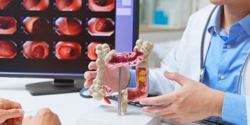 50% of Colon Cancer Cases in Young People Tied to 1 Common Factor, Researchers Discover
