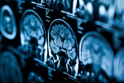 Dementia cases are skyrocketing in China and no one knows why