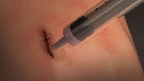 Breakthrough surgical glue seals wounds shut in 60 seconds