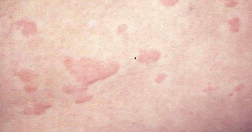 Four side effects linked to Pfizer and Moderna vaccines
