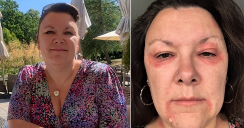'Eczema caused by menopause made me look like a vampire - until I found £9.50 Hydrosil Dry Eye Gel cream'