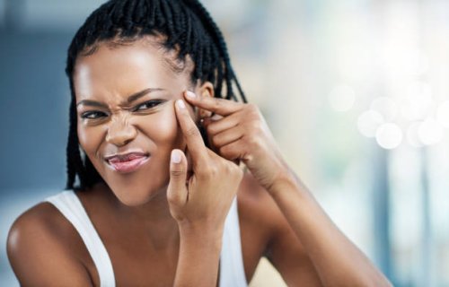 Over 30 & Still Have Acne? Here’s How to Get It Under Control