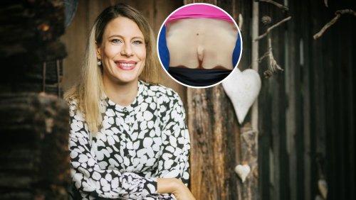 Sonia Kälin zeigt Riesen-Spalt: Das können Frauen tun, um eine Rektusdiastase zu heilen
