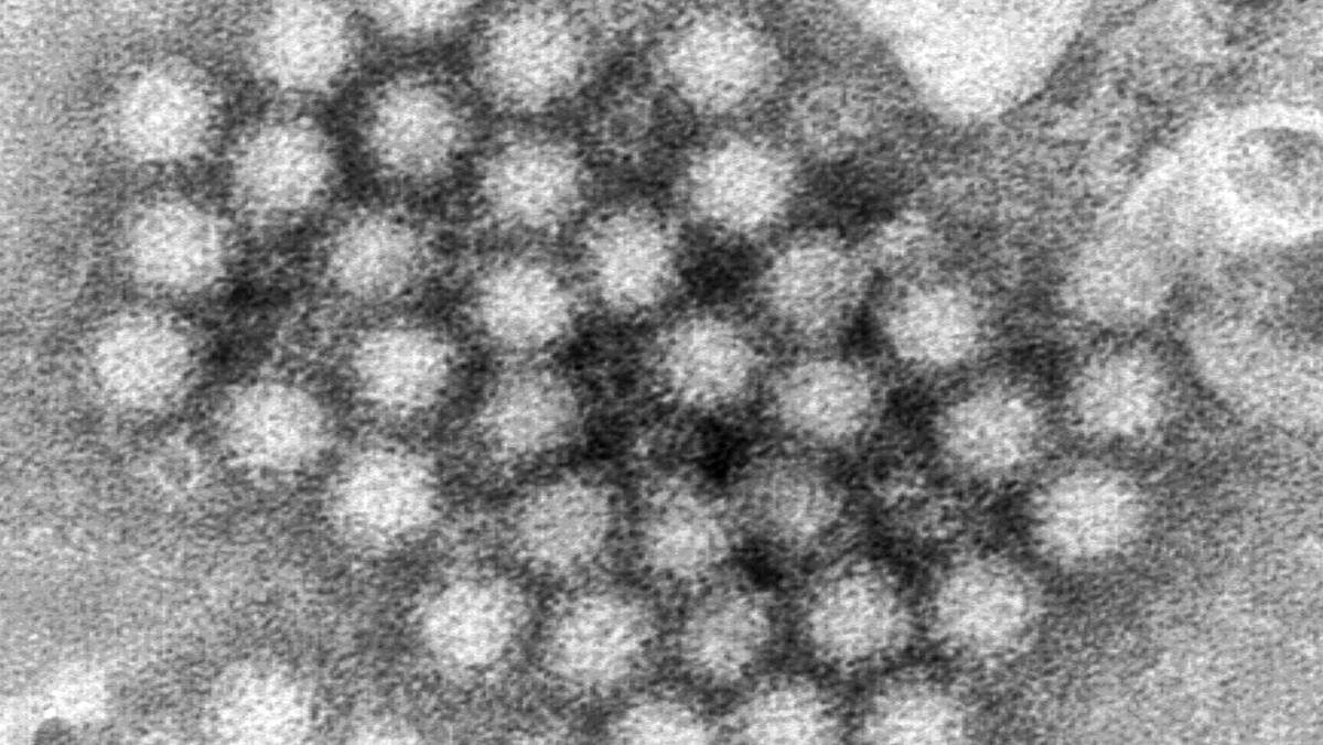 Raststätte gesperrt: Norovirus-Notfall in Pieterlen BE – 18 Car-Passagiere landen im Spital