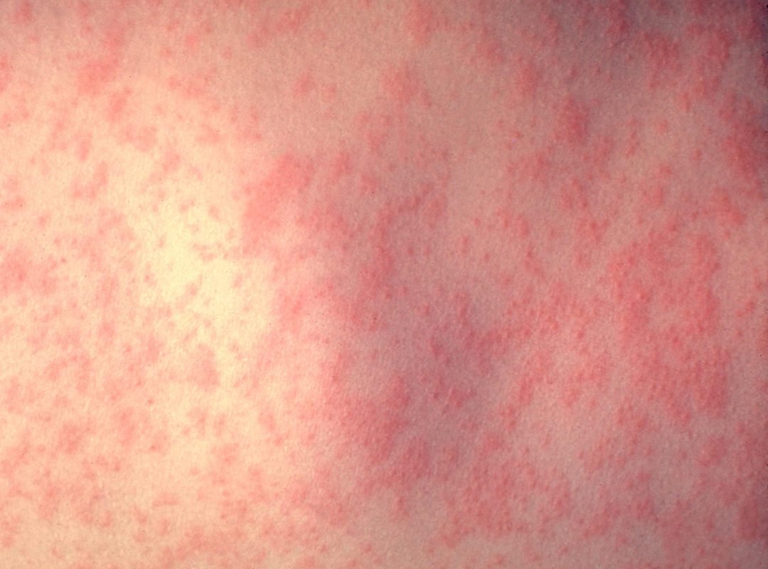 CDC buries report on effectiveness of measles vaccine